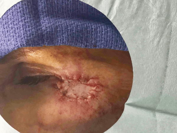 Excision Eye Patient 03 Before - 2