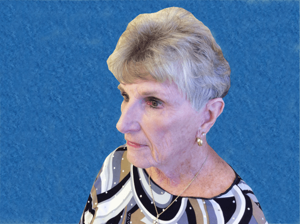 Excision Eye Patient 03 After - 2