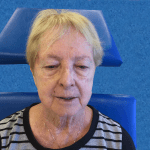 Mohs Face Patient 09 Thumbnail Before