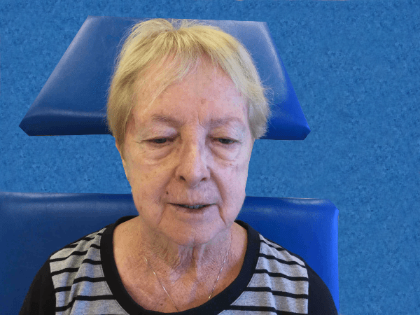 Mohs Face Patient 09 Before