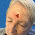 Mohs Face Patient 09 Thumbnail After