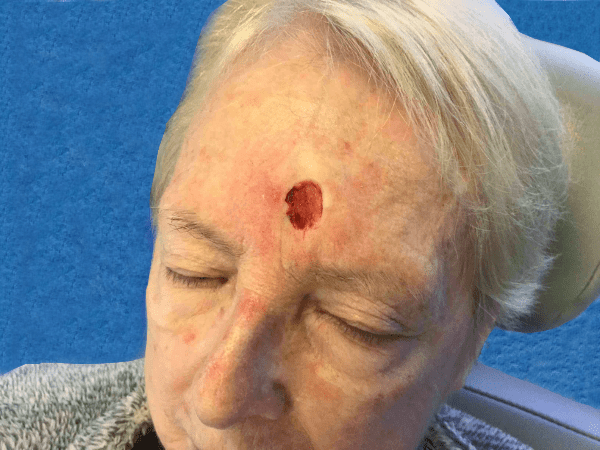 Mohs Face Patient 09 After