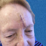 Mohs Face Patient 09 Thumbnail Before - 2