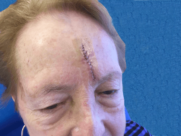 Mohs Face Patient 09 Before - 2