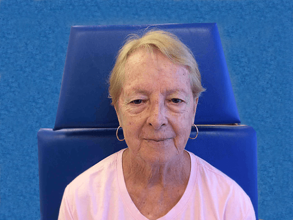 Mohs Face Patient 09 After - 2