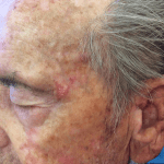 Mohs Face Patient 08 Thumbnail Before