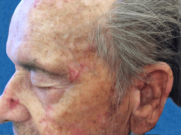 Mohs Face Patient 08 Before