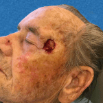 Mohs Face Patient 08 Thumbnail After