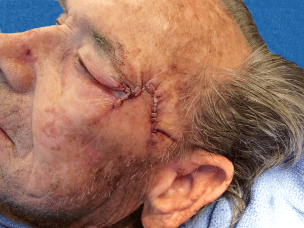 Mohs Face Patient 08 Before - 2