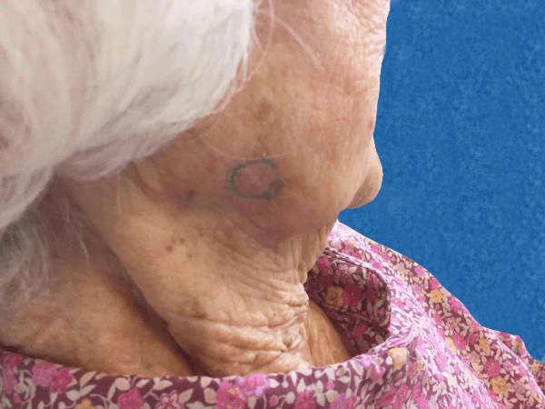 Mohs Face Patient 10 Before