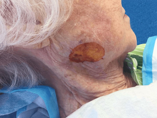 Mohs Face Patient 10 After