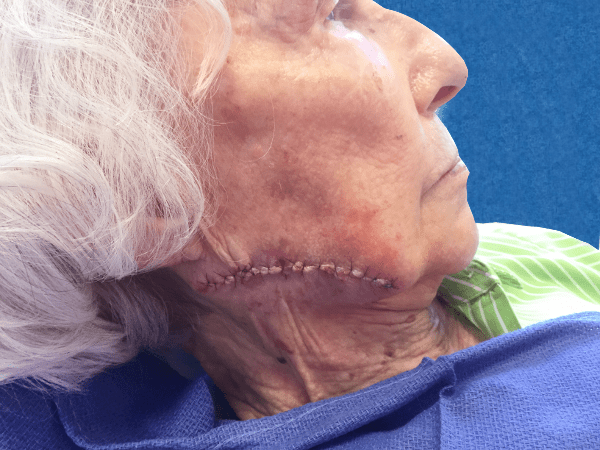 Mohs Face Patient 10 Before - 2