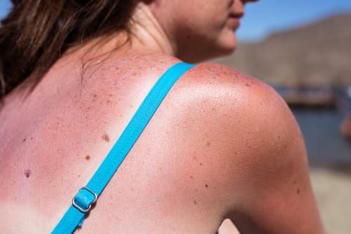 Sunburn from beach sun light on the shoulder and back of caucasian girl-img-blog