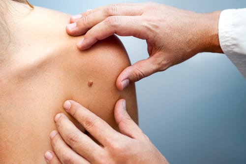 doctor looking at skin-img-blog