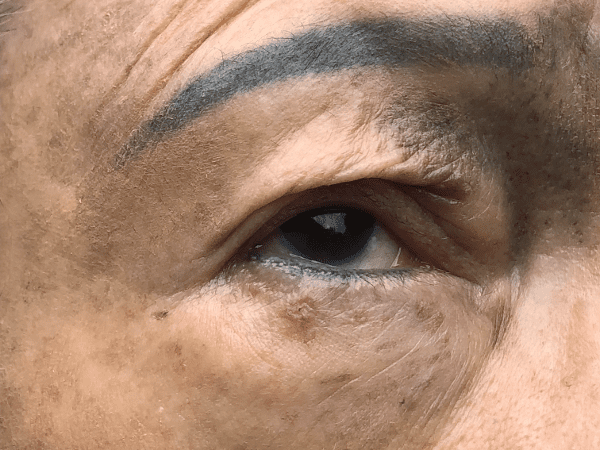 Mohs Eye Patient 04 Before