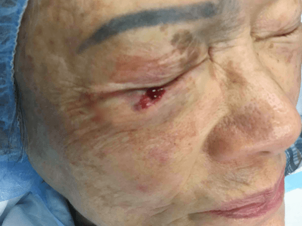 Mohs Eye Patient 04 After