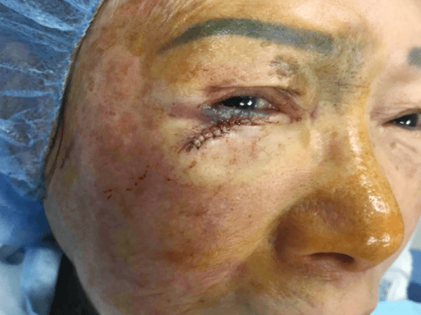 Mohs Eye Patient 04 Before - 2