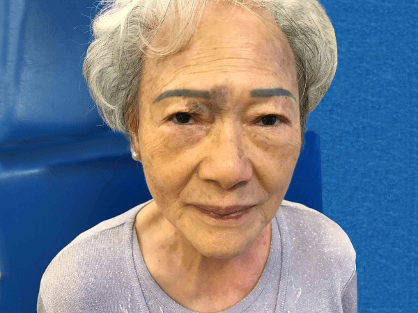 Mohs Eye Patient 04 After - 2