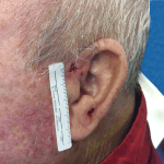 Mohs Ear Patient 07 Thumbnail Before