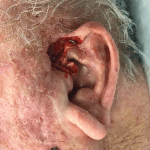 Mohs Ear Patient 07 Thumbnail After