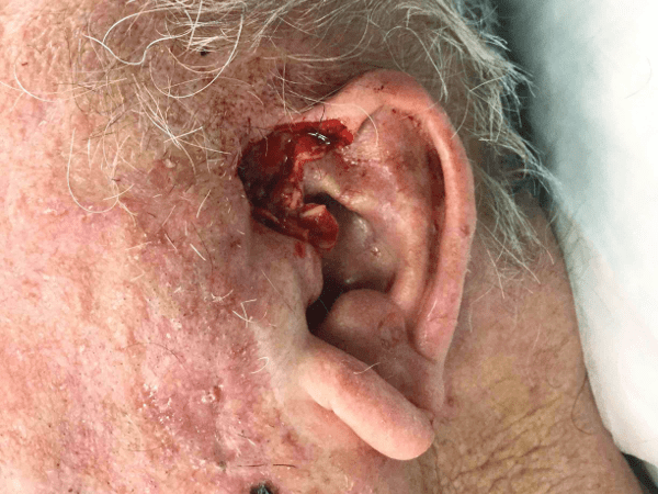 Mohs Ear Patient 07 After