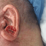Mohs Ear Patient 07 Thumbnail Before - 2
