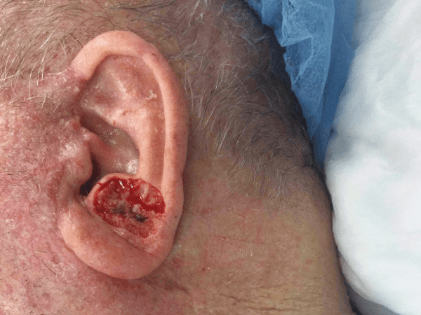 Mohs Ear Patient 07 Before - 2
