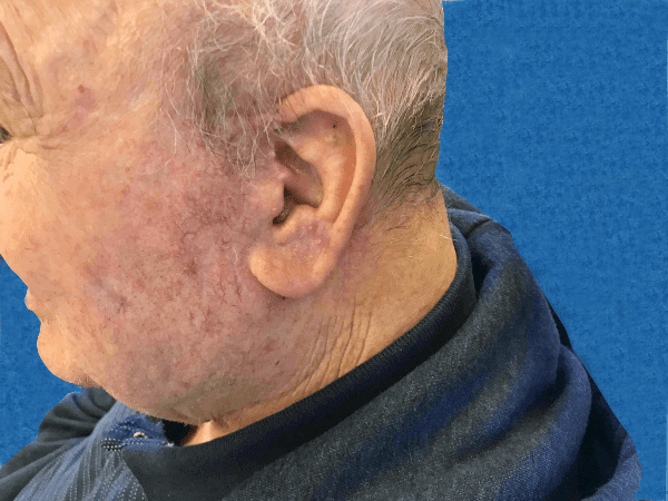 Mohs Ear Patient 07 After - 2