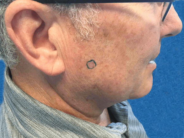 Mohs Face Patient 11 Before