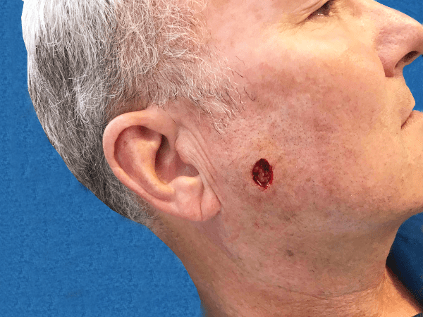 Mohs Face Patient 11 After