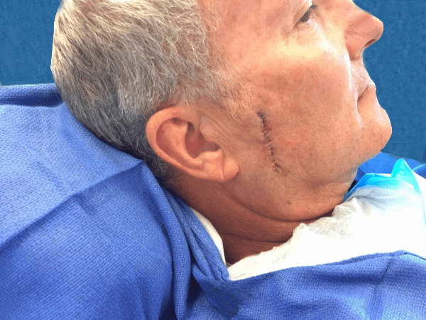 Mohs Face Patient 11 Before - 2