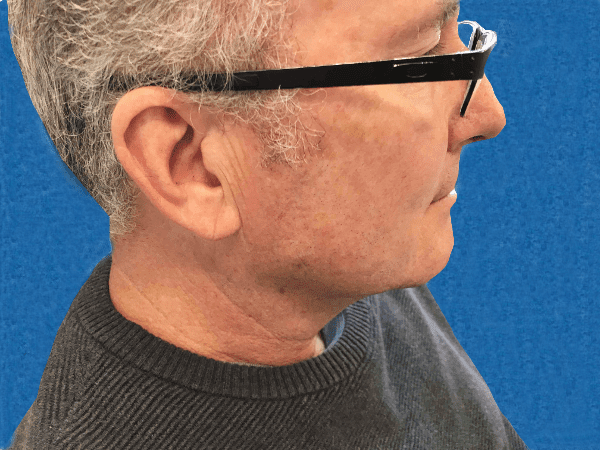 Mohs Face Patient 11 After - 2