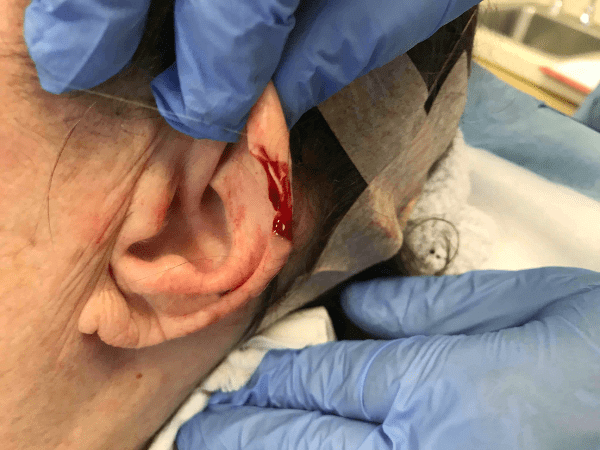 Mohs Ear Patient 08 After