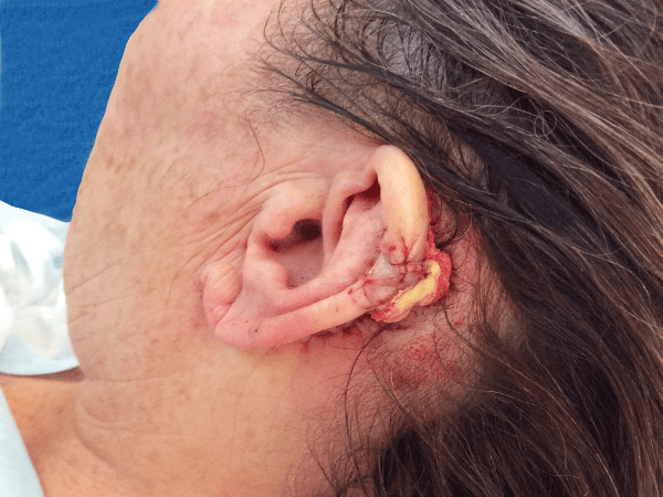 Mohs Ear Patient 08 Before - 2
