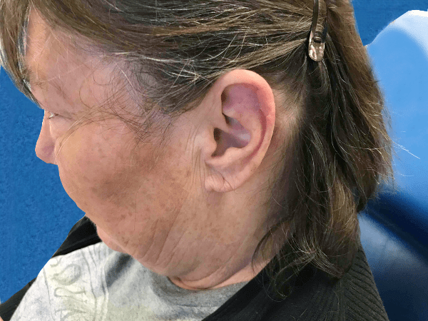 Mohs Ear Patient 08 After - 2