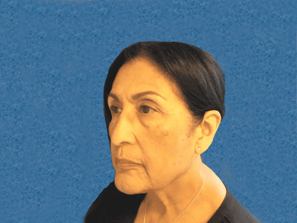 Blepharoplasty Patient 04 After