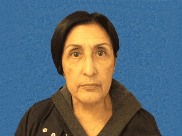 Blepharoplasty Patient 04 Before - 2