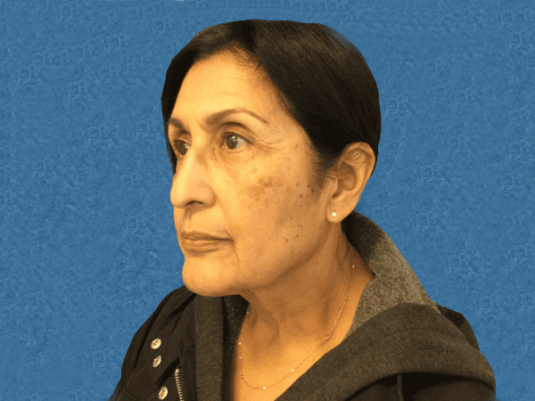 Blepharoplasty Patient 04 After - 2