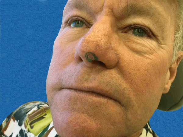 Mohs Nose Patient 20 Before