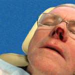 Mohs Nose Patient 20 Thumbnail After