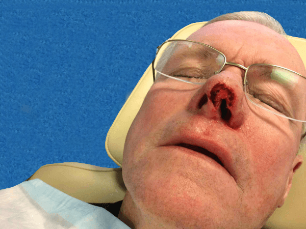 Mohs Nose Patient 20 After