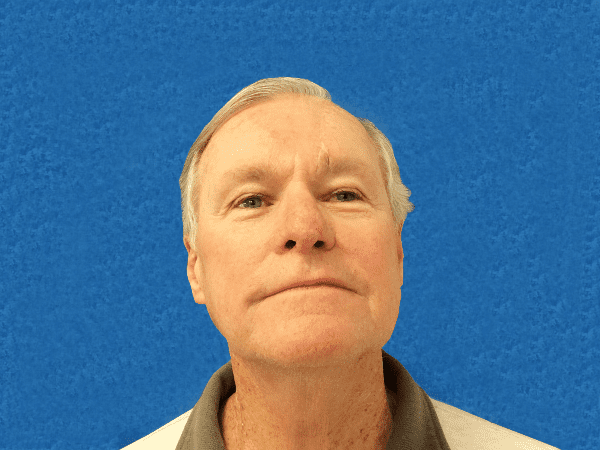 Mohs Nose Patient 20 After - 2