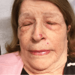 Mohs Nose Patient 21 Thumbnail Before