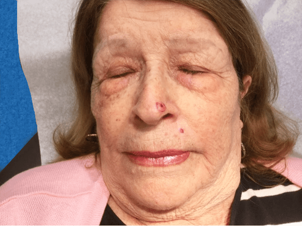 Mohs Nose Patient 21 Before