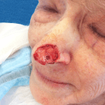 Mohs Nose Patient 21 Thumbnail After