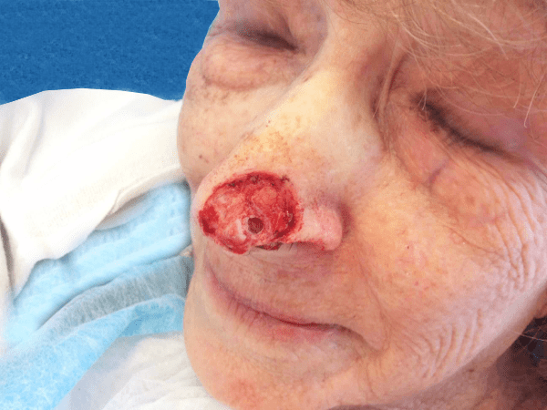 Mohs Nose Patient 21 After