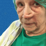 Mohs Nose Patient 21 Thumbnail Before - 2