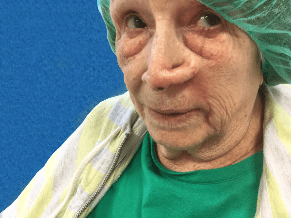 Mohs Nose Patient 21 Before - 2