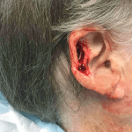 Mohs Ear Patient 09 Thumbnail Before