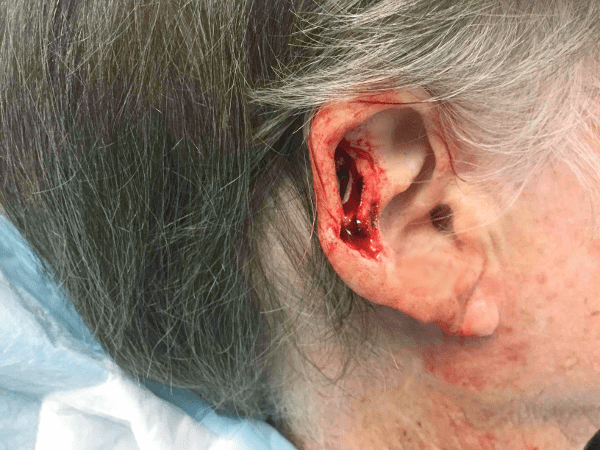 Mohs Ear Patient 09 Before